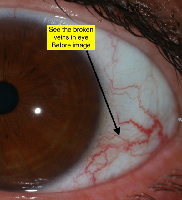 Genetic Iris Analysis